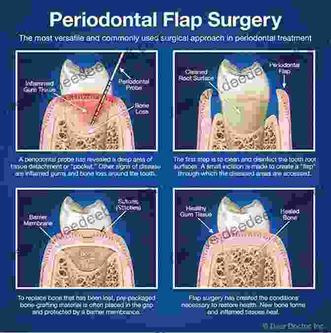 Flap Surgery Being Performed To Access And Treat Severe Periodontal Disease Advances In Periodontal Surgery: A Clinical Guide To Techniques And Interdisciplinary Approaches