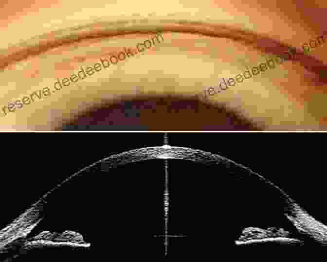 Gonioscopic Findings In Angle Closure Glaucoma, Showing A Closed Angle With The Iris Touching The Trabecular Meshwork. Gonioscopy: A Text And Atlas