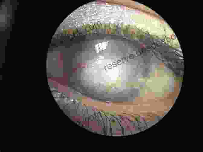 Gonioscopic Findings In Corneal Scarring, Showing Corneal Opacities And Neovascularization Extending Into The Anterior Chamber Angle. Gonioscopy: A Text And Atlas