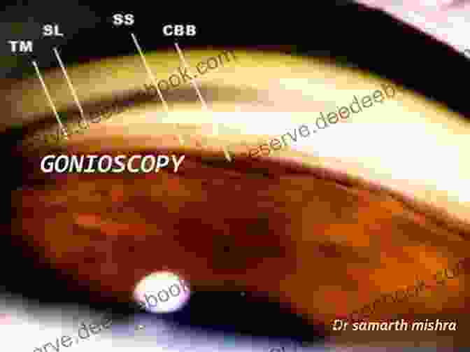 Gonioscopic Findings In Open Angle Glaucoma, Showing A Narrow Angle With An Occluded Trabecular Meshwork. Gonioscopy: A Text And Atlas