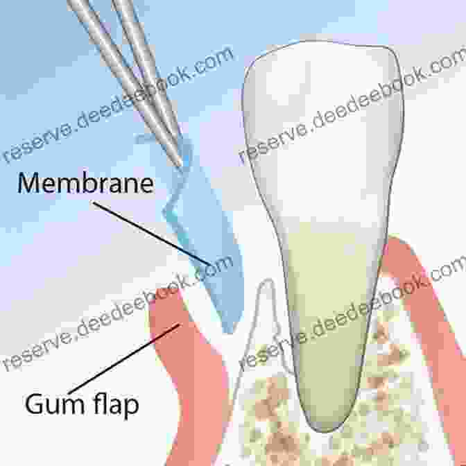 Guided Tissue Regeneration Membrane Being Placed Over A Diseased Area Advances In Periodontal Surgery: A Clinical Guide To Techniques And Interdisciplinary Approaches