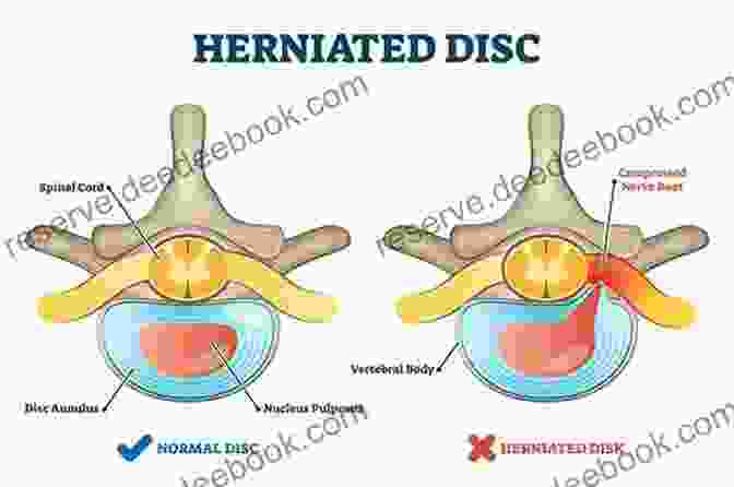 Herniated Disc Diseases Of The Vertebral Column Miniatlas