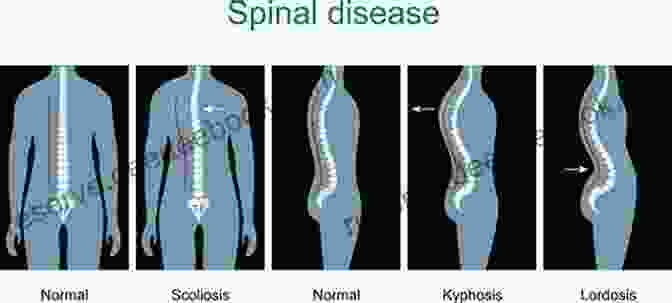 Lordosis Diseases Of The Vertebral Column Miniatlas