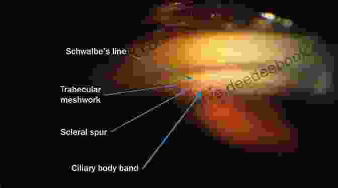 Normal Gonioscopic Findings, Showing A Wide Open Angle With Well Defined Angle Structures. Gonioscopy: A Text And Atlas