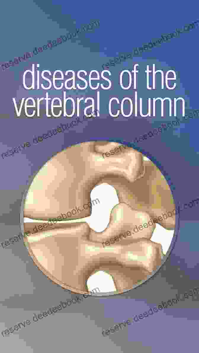 Osteoporosis Diseases Of The Vertebral Column Miniatlas