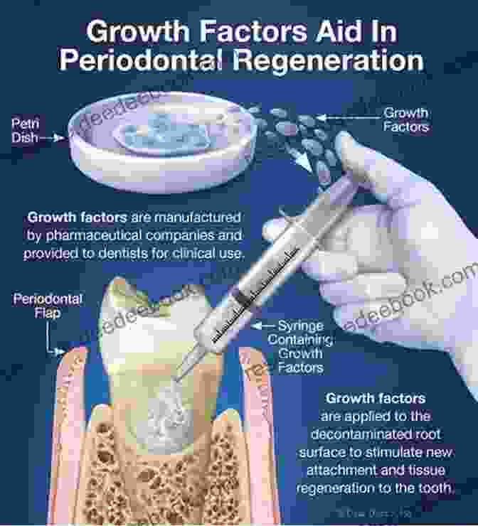 Periodontal Regeneration Utilizing Growth Factors And Membranes To Stimulate The Growth Of New Periodontal Tissue Advances In Periodontal Surgery: A Clinical Guide To Techniques And Interdisciplinary Approaches