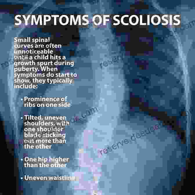Scoliosis Diseases Of The Vertebral Column Miniatlas