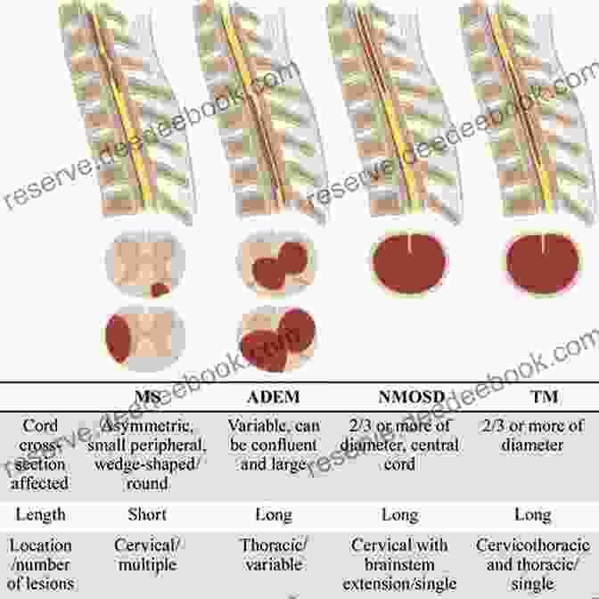 Spinal Cord Injury Diseases Of The Vertebral Column Miniatlas