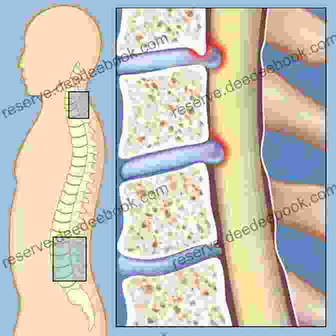 Spinal Stenosis Diseases Of The Vertebral Column Miniatlas